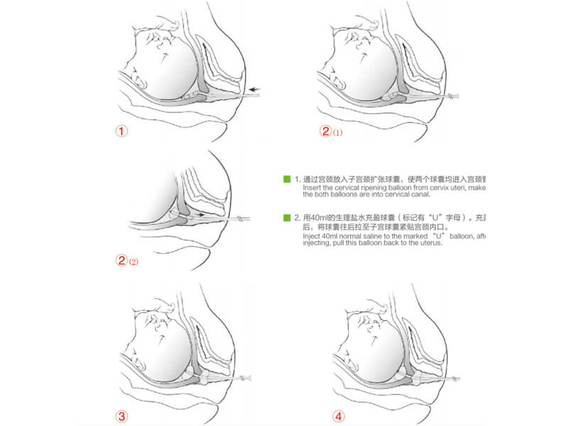 Cervical Ripening Balloon  Procedure